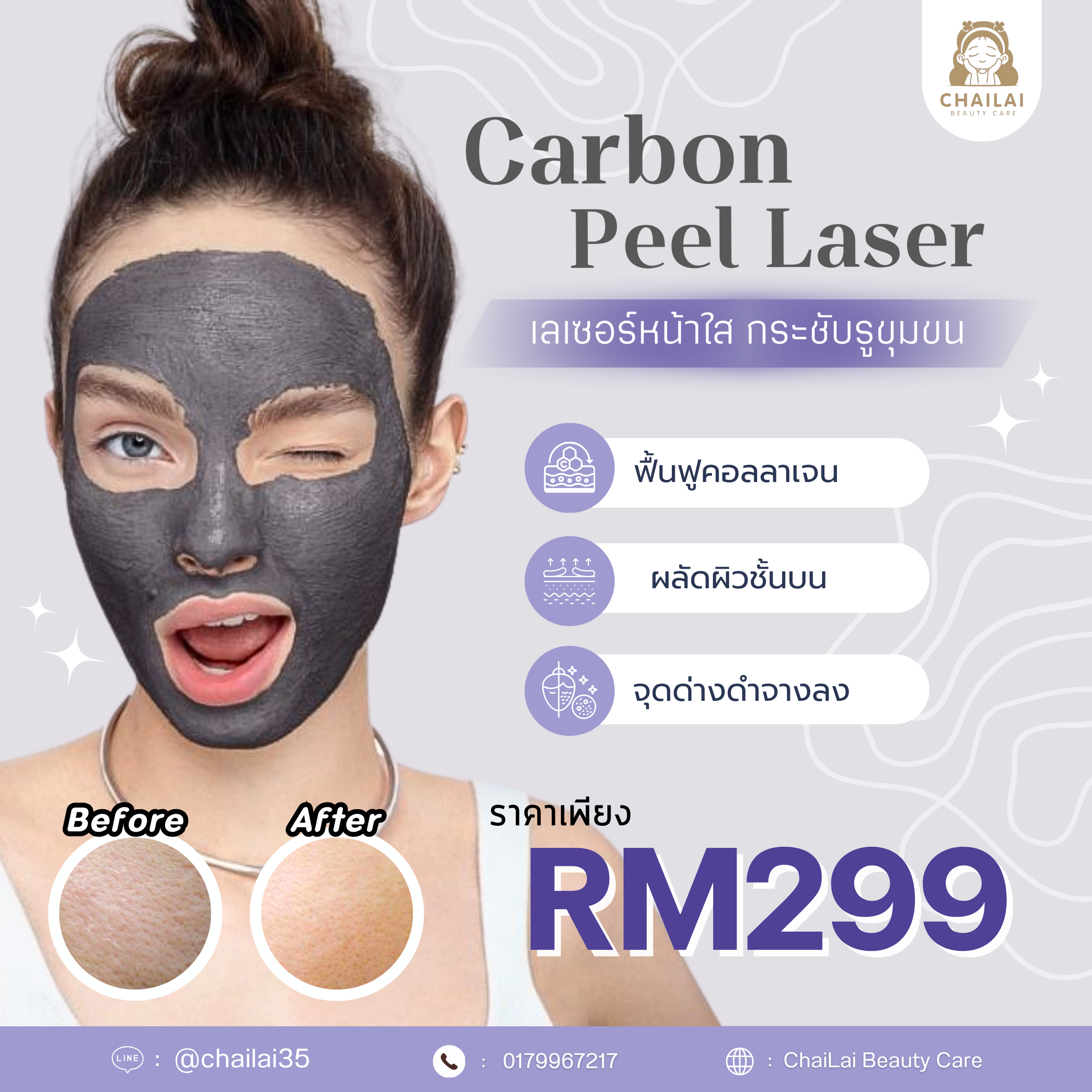 Carbon Peel Laser 1